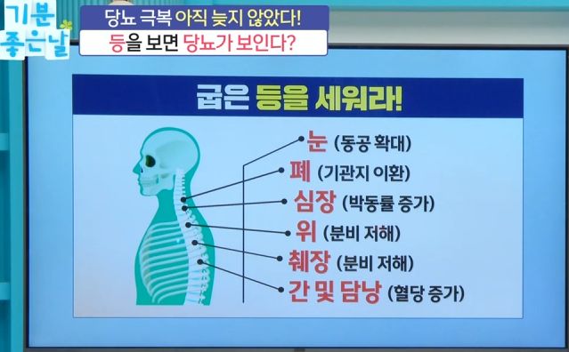 등을 보면 당뇨가 보인다 4 image 4