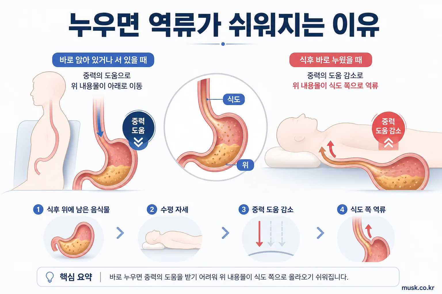 밥 먹고 바로 누우면 위산 역류가 생기나요? 5 식후 누운 자세에서 위 내용물이 식도로 올라가는 과정을 설명한 그림