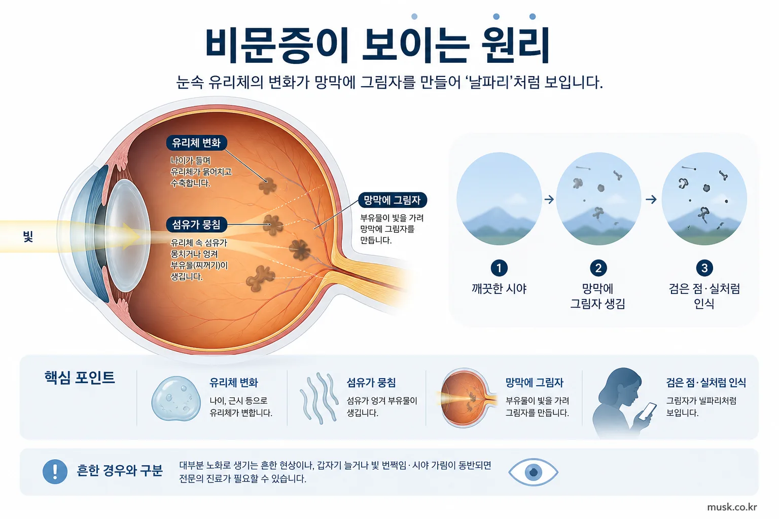 유리체 변화로 망막에 그림자가 생겨 비문증이 보이는 원리