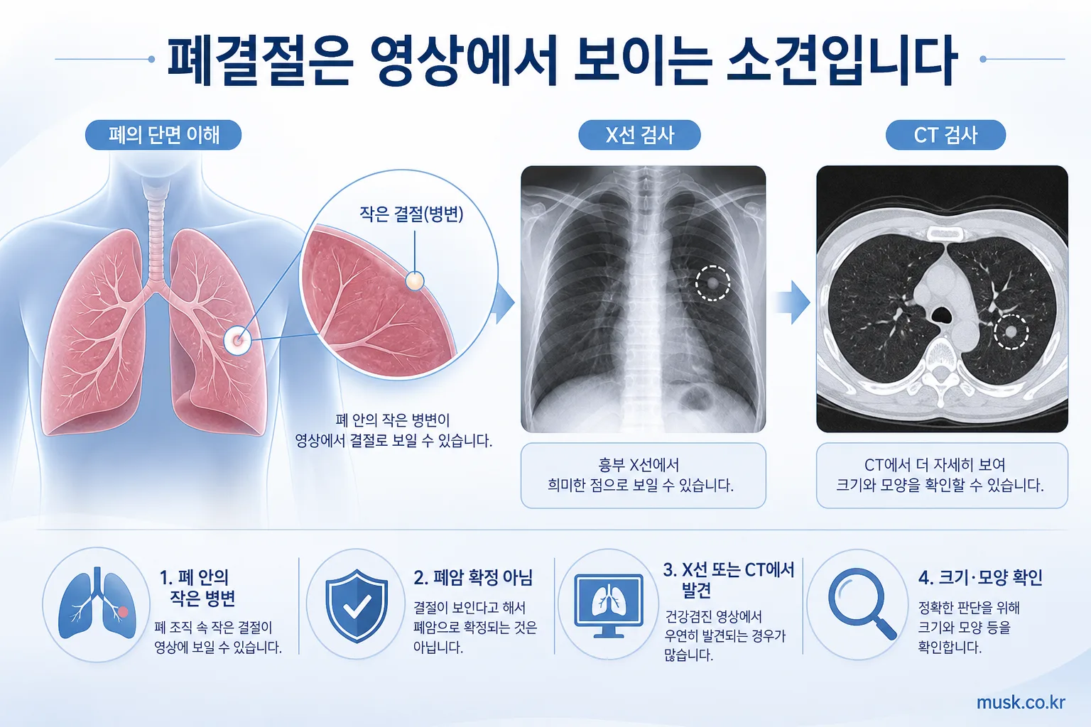 흉부 X선과 CT에서 관찰되는 폐결절 설명 이미지