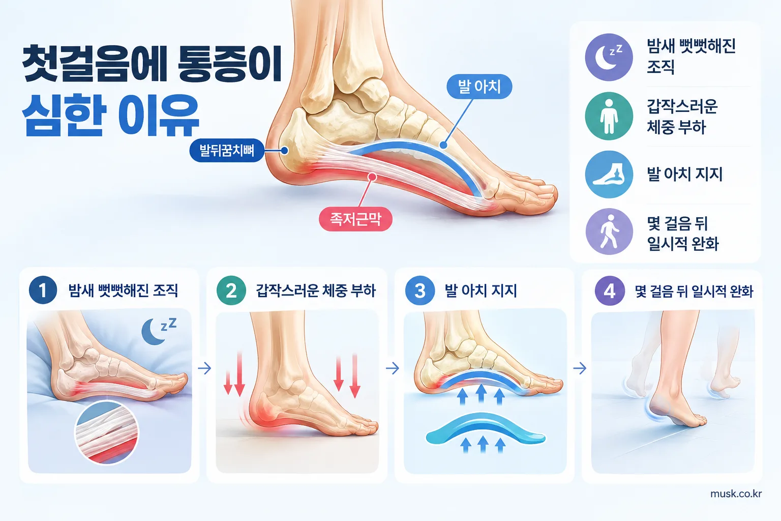 족저근막이 발뒤꿈치에서 발가락 방향으로 이어져 발의 아치를 지지하는 구조