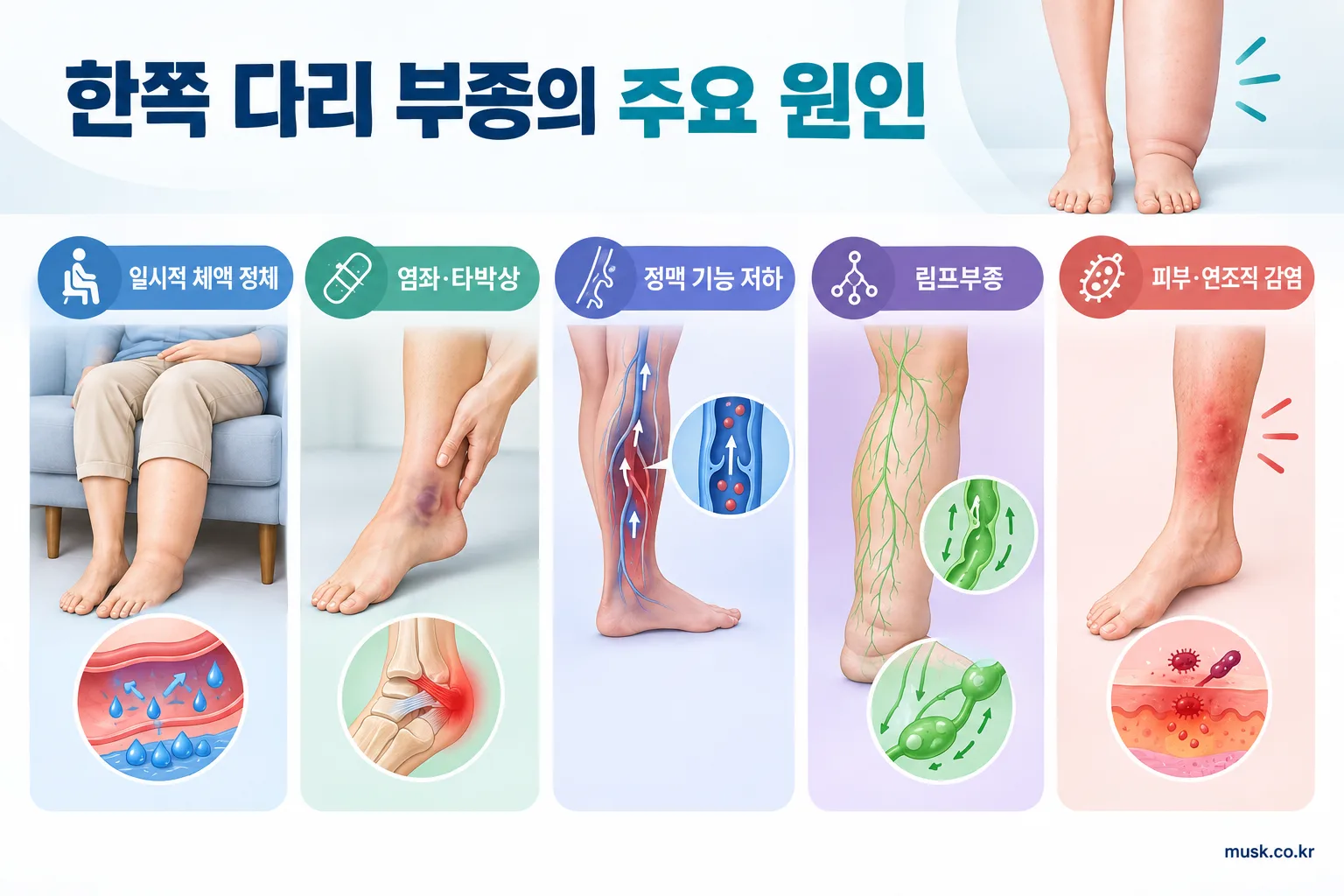 일시적 부종, 손상, 정맥 기능 저하, 림프부종, 감염 등 한쪽 다리 부종의 주요 원인