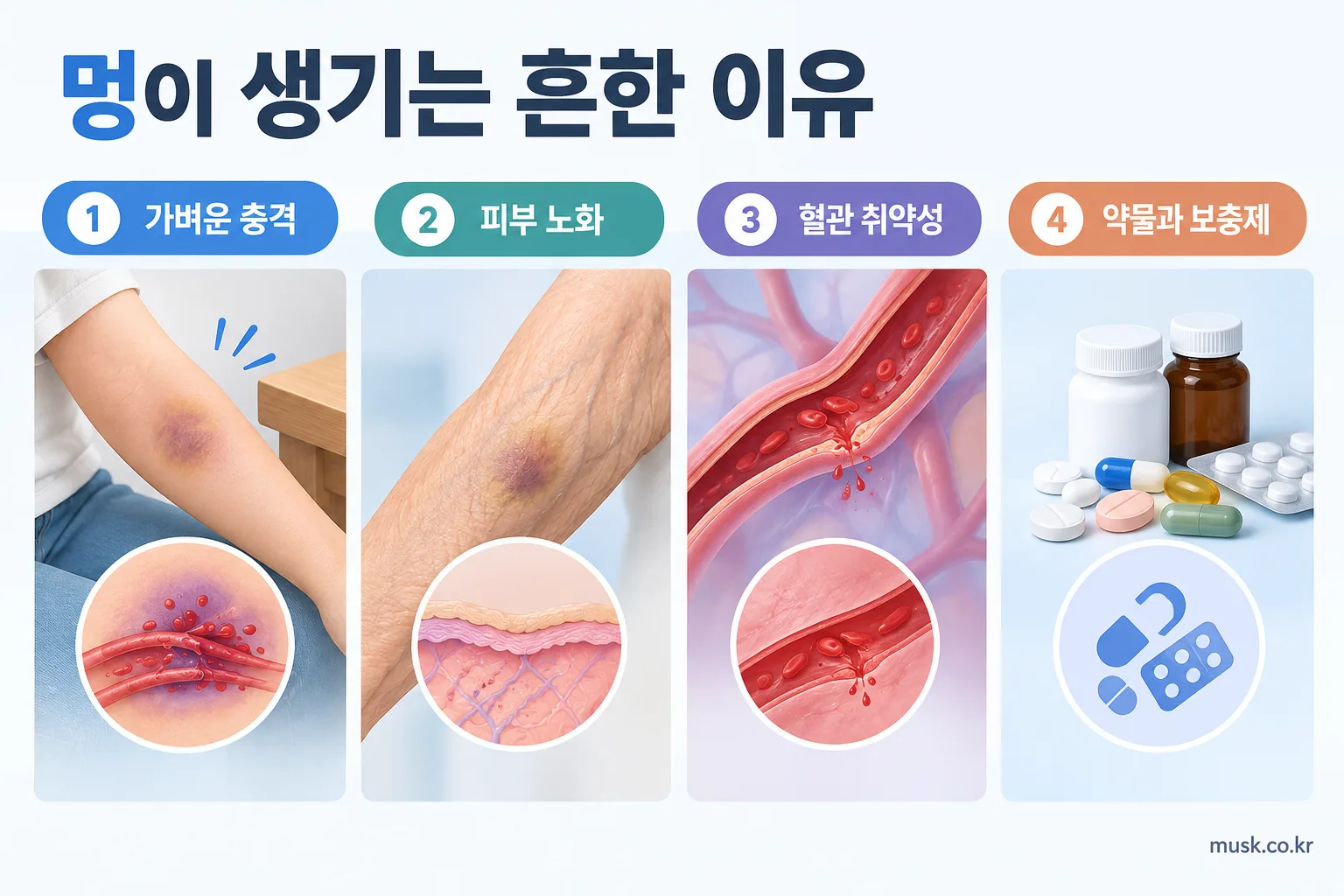 별다른 이유 없이 멍이 잘 드는 이유는 무엇일까 2 가벼운 충격과 피부 노화, 약물 등이 멍이 잘 생기는 이유가 될 수 있음을 설명하는 인포그래픽