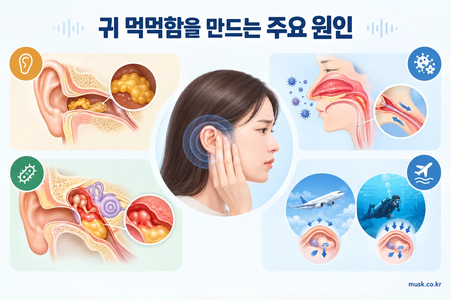 한쪽 귀가 먹먹하고 잘 안 들리는 이유 2 귀지와 감기, 중이염, 압력 변화로 생길 수 있는 귀 먹먹함