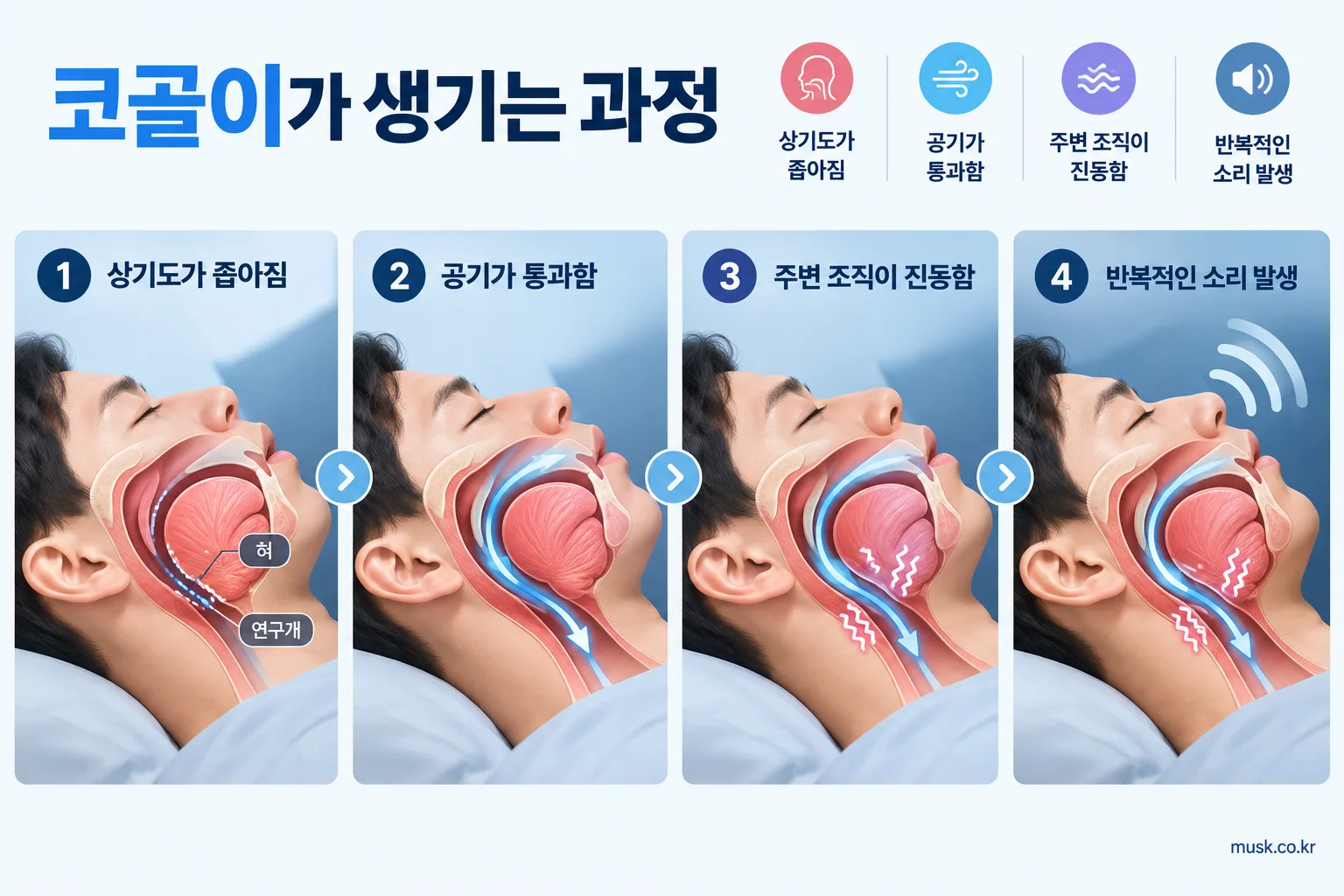 코를 고는 이유와 그냥 넘기면 안 되는 경우 2 상기도가 좁아지고 공기가 지나가며 주변 조직이 진동하는 코골이 발생 과정