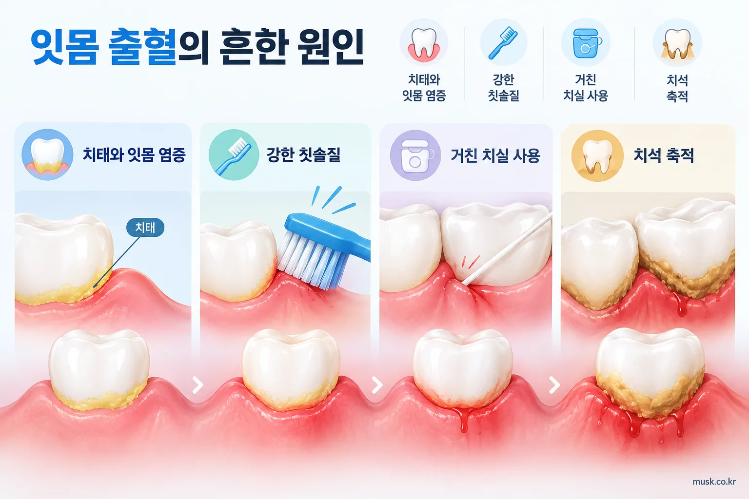양치할 때 잇몸에서 피가 나는 이유와 확인할 점 2 치태와 강한 칫솔질 등 잇몸 출혈의 흔한 원인을 설명하는 일러스트