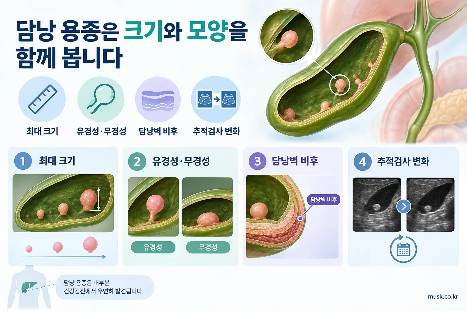 건강검진에서 담낭 용종이 보였다는 말은 무슨 뜻인가 2 담낭 용종의 크기와 형태 및 담낭벽 변화를 확인하는 인포그래픽
