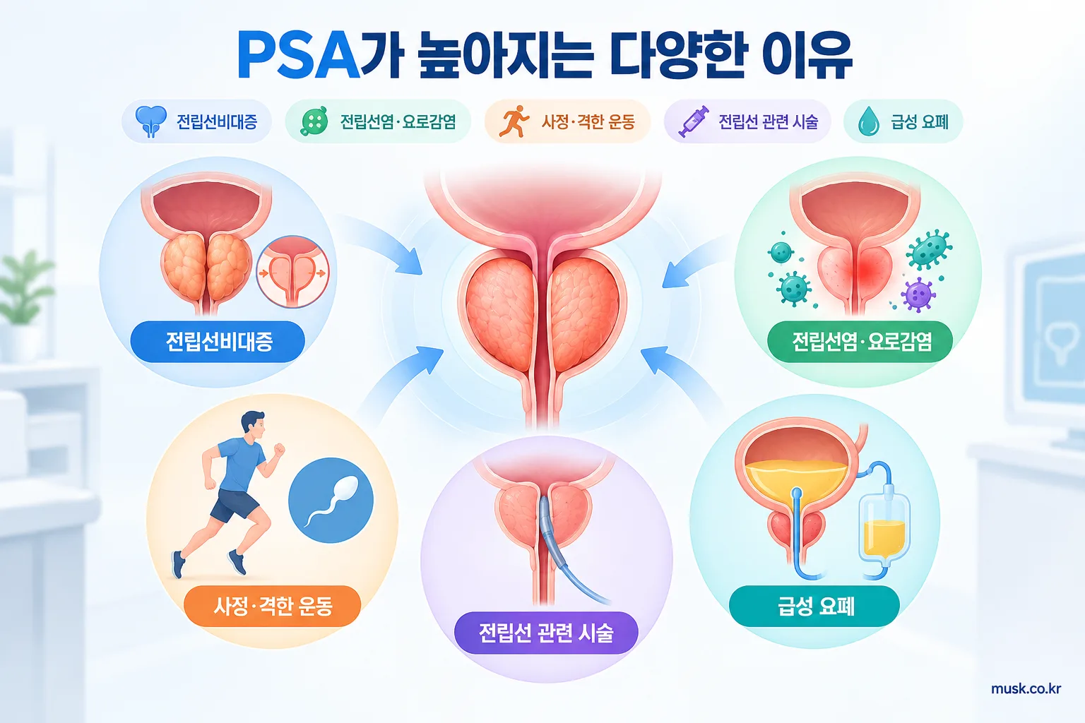 건강검진에서 PSA 수치가 높은 이유는 무엇인가 2 전립선비대증과 전립선염, 운동, 시술, 급성 요폐 등 PSA 상승 원인을 설명하는 인포그래픽