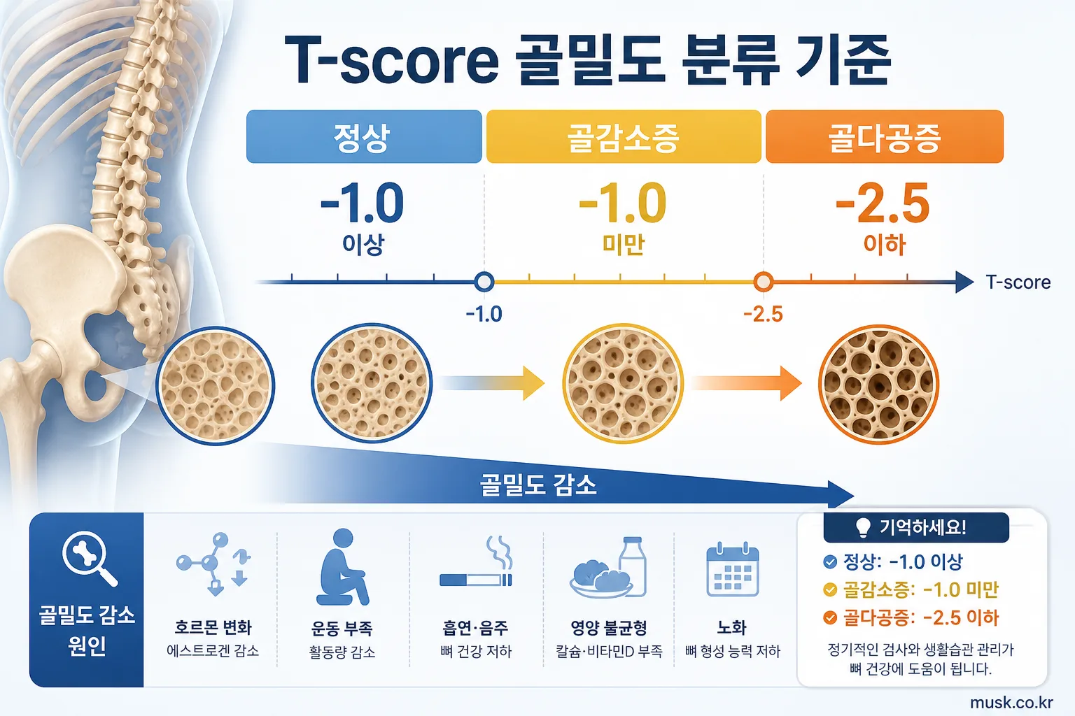 골밀도 검사 T-score는 무슨 뜻인가요? 2 정상 골밀도, 골감소증, 골다공증으로 나뉘는 T-score 기준 인포그래픽