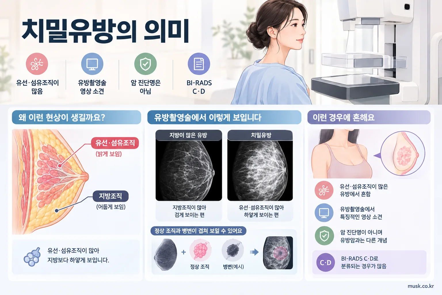 유방촬영술에서 유선과 섬유조직이 많이 보이는 치밀유방 설명