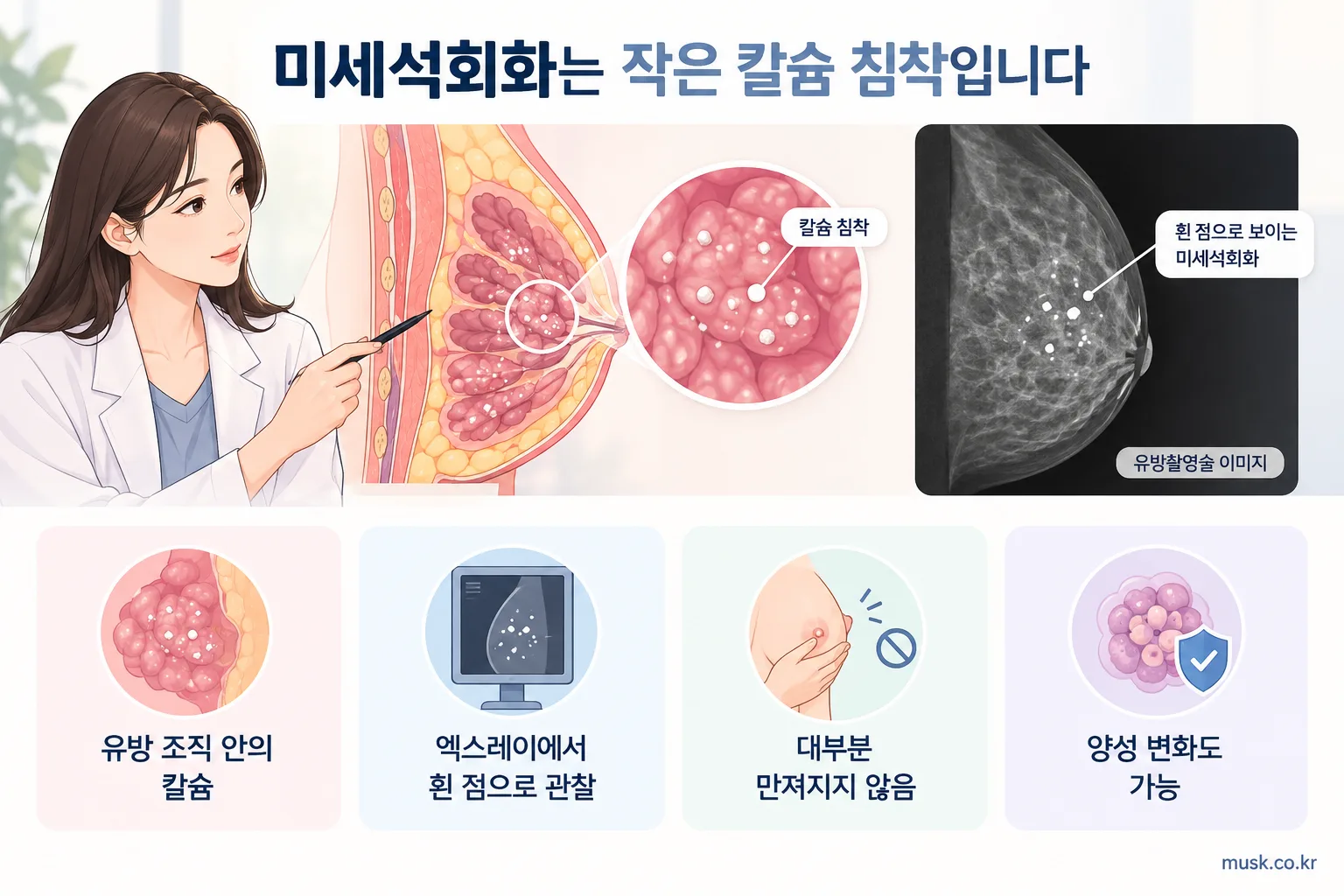 유방 조직 안의 작은 칼슘 침착과 유방촬영술에서 보이는 흰 점